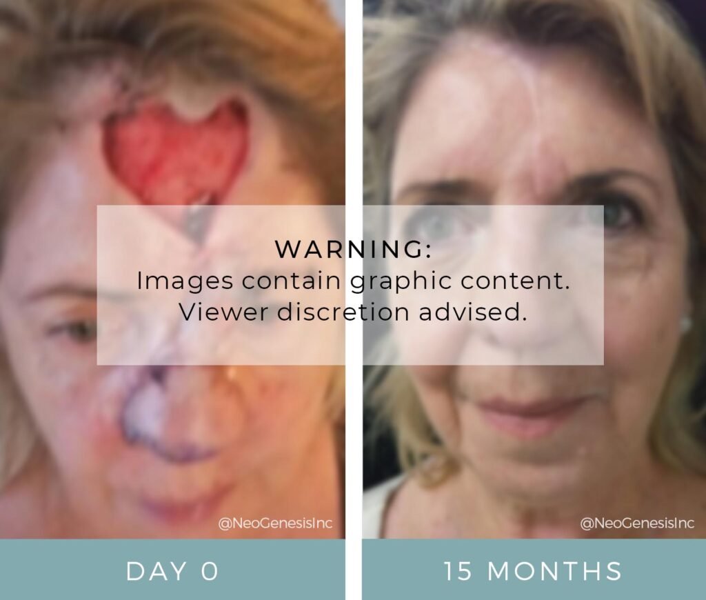 Before + After - Basal Cell Carcinoma Surgery