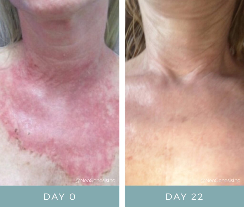 Before + After - Chemical Peel + Radiation