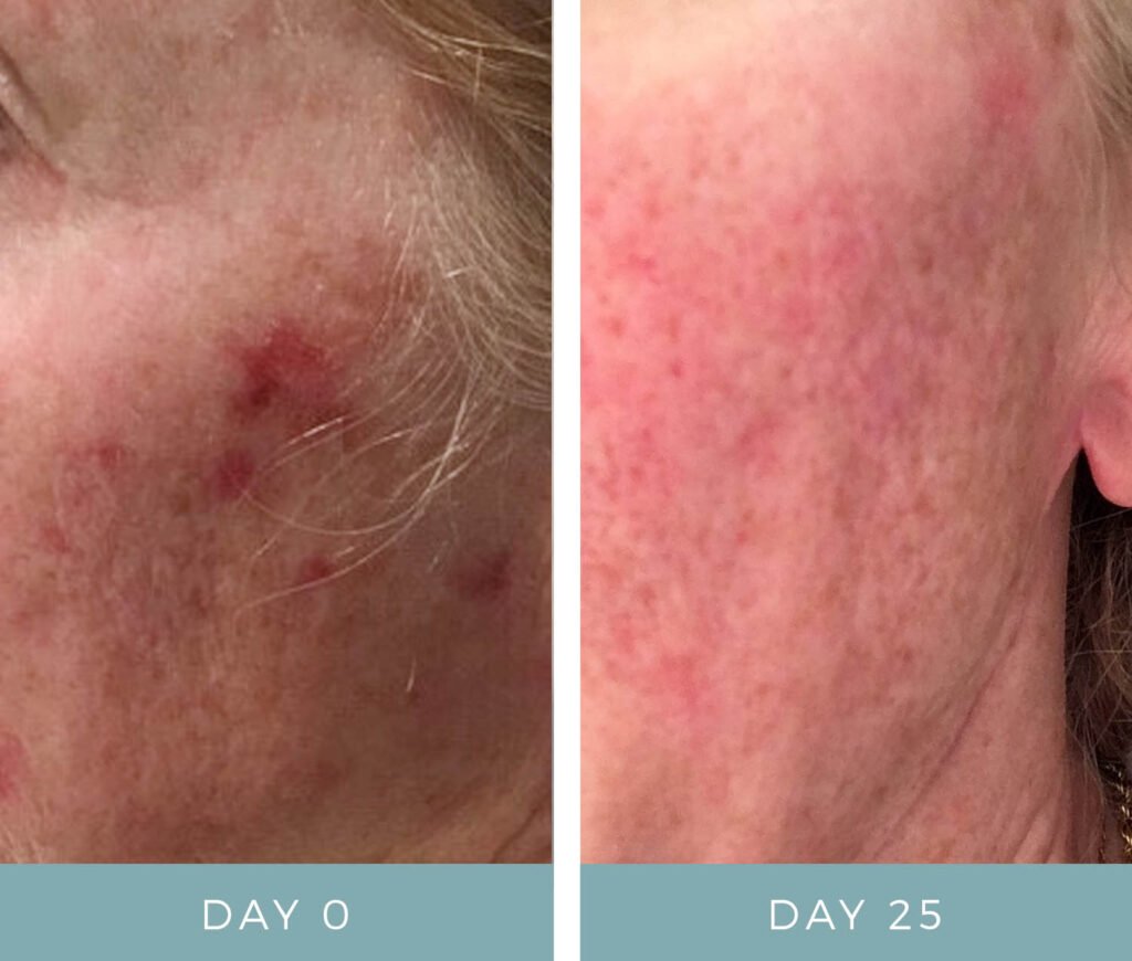 Before + After - Side Effects from Fluorouracil
