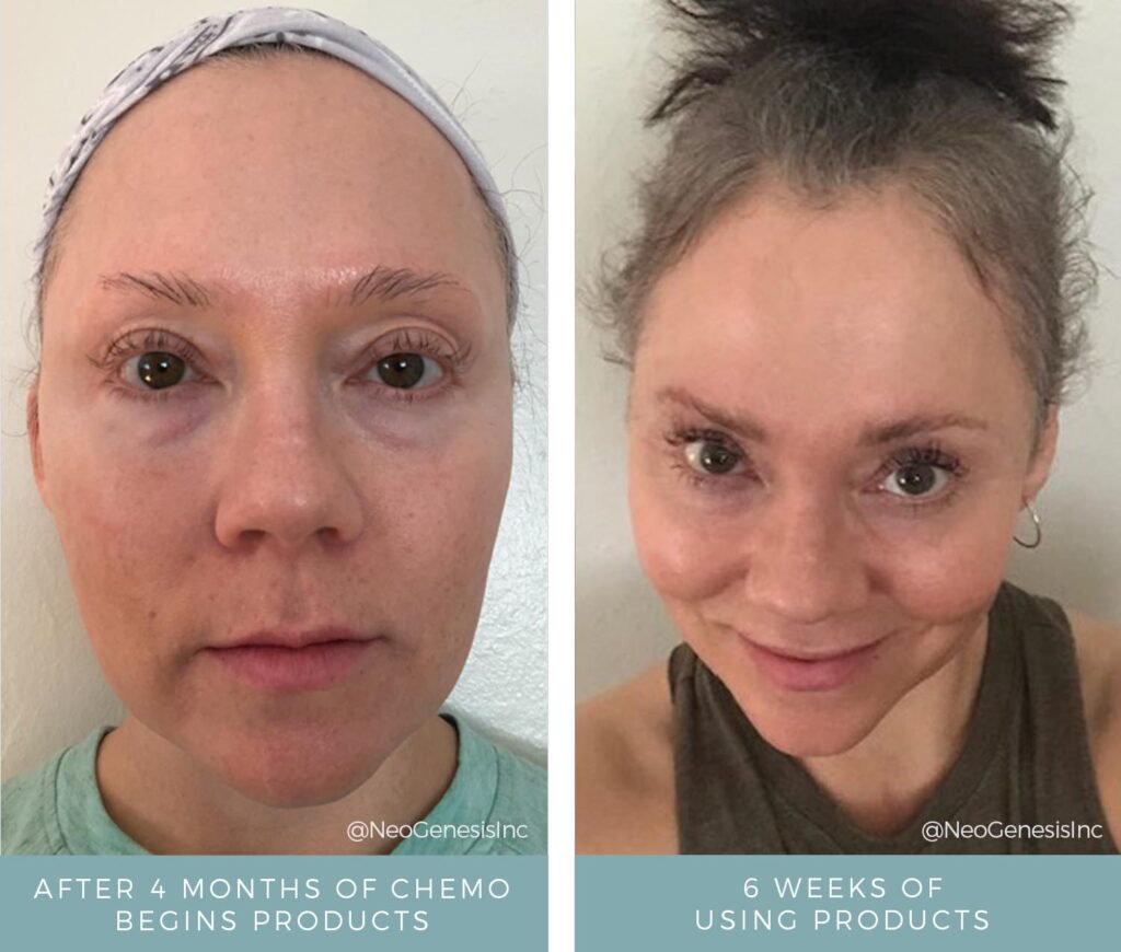 Before + After - Chemo Hair, Lash and Brow Loss