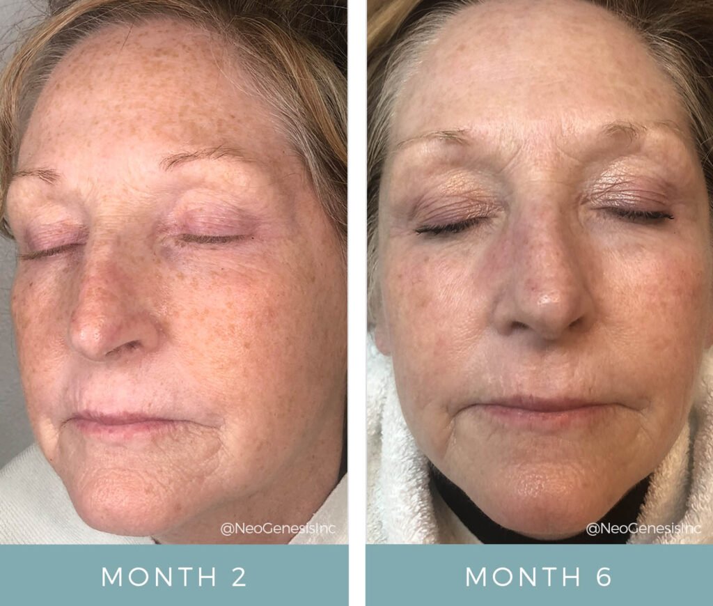 Before + After - Chronically Dry Skin from Chemo