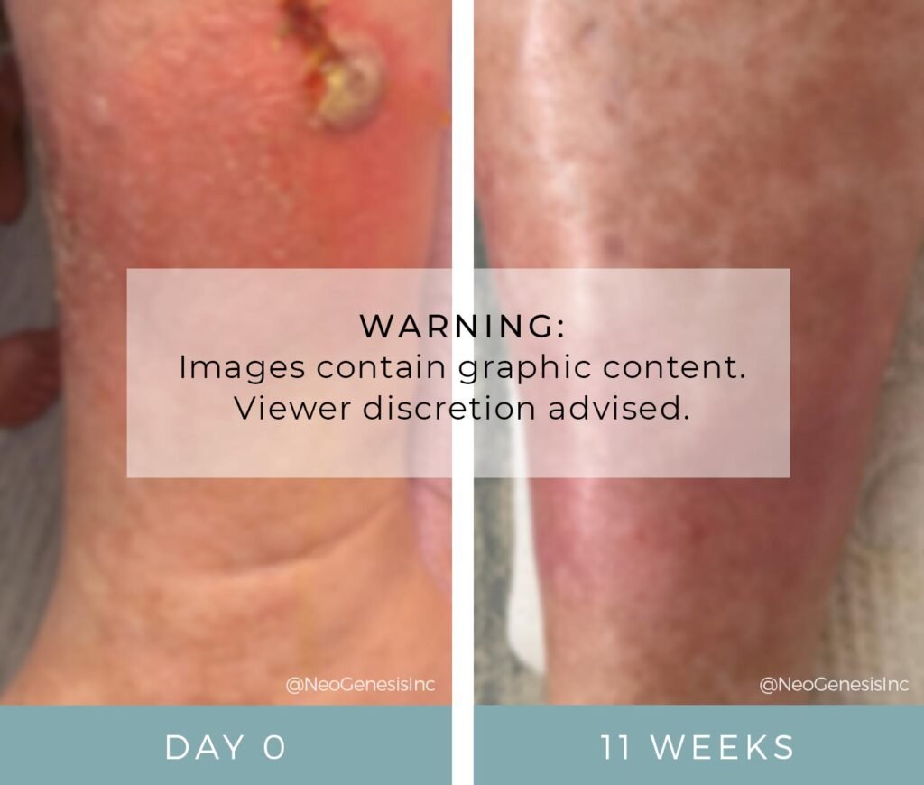 Before + After - Diabetic Ulcers