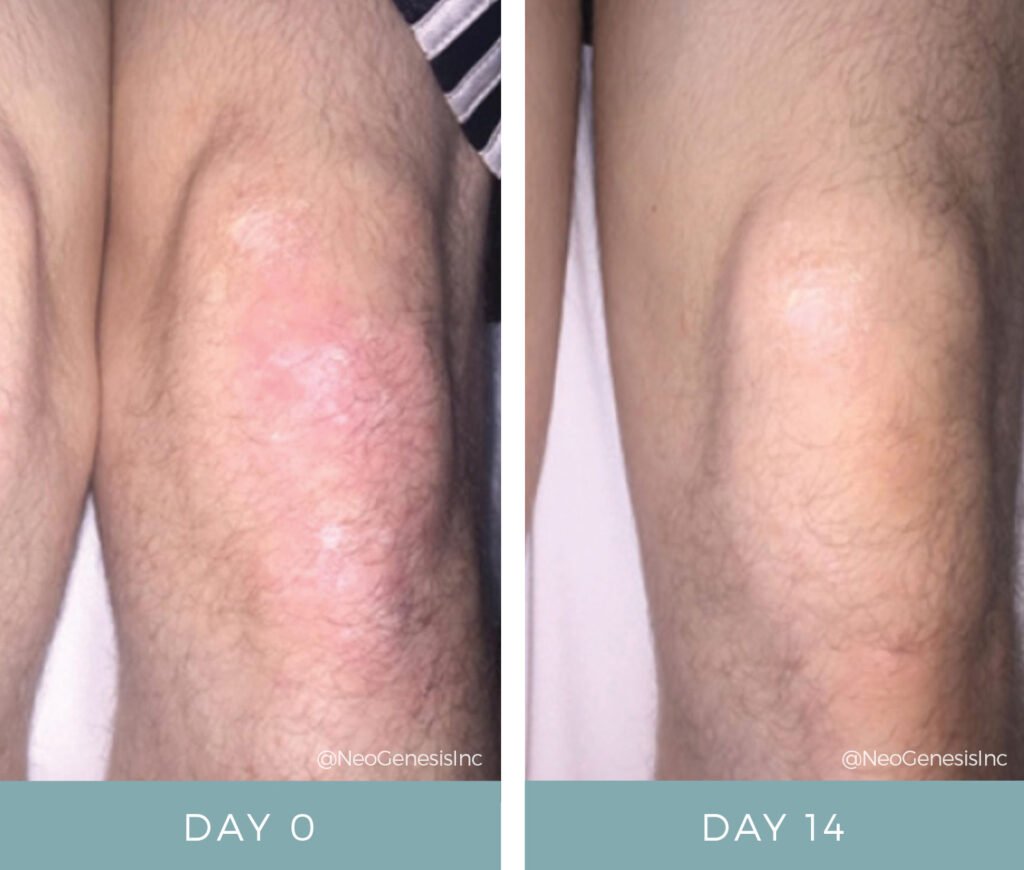 Before + After - Eczema on Right Leg