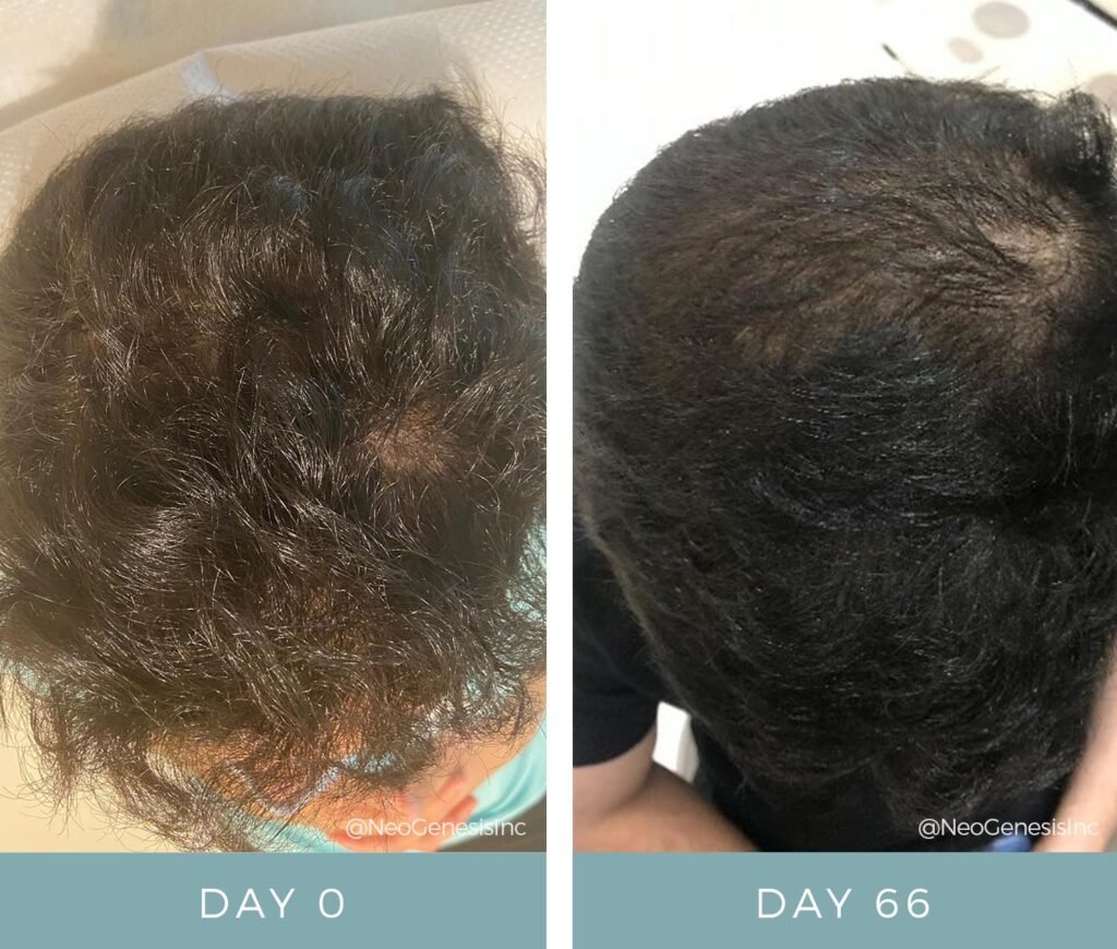 Before + After - Hair Loss + Microneedling