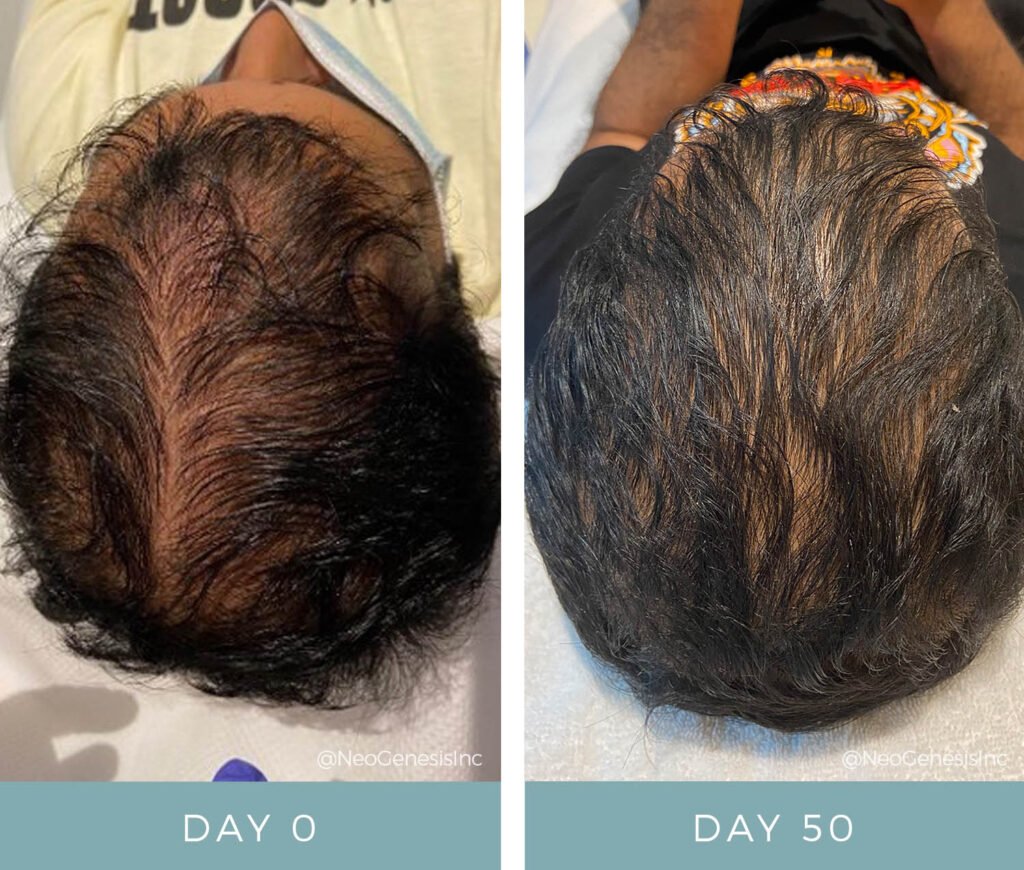 Before + After - Microneedling for Hair Loss