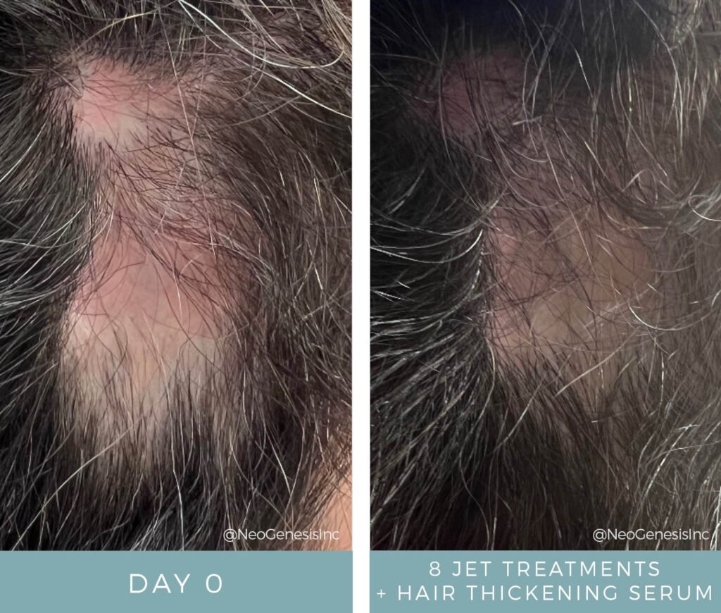 Hair Loss - Before + After Jet Treatments + Hair Thickening Serum