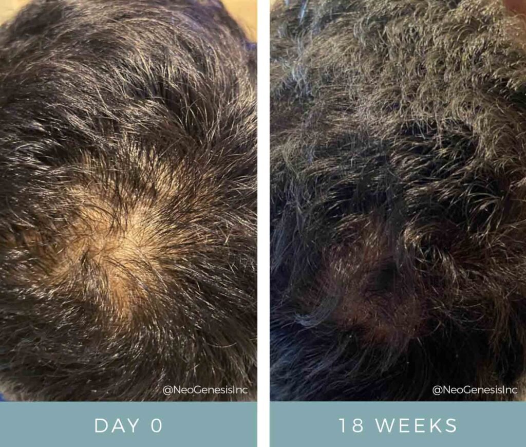 Before + After - Microneedling for Hair Loss