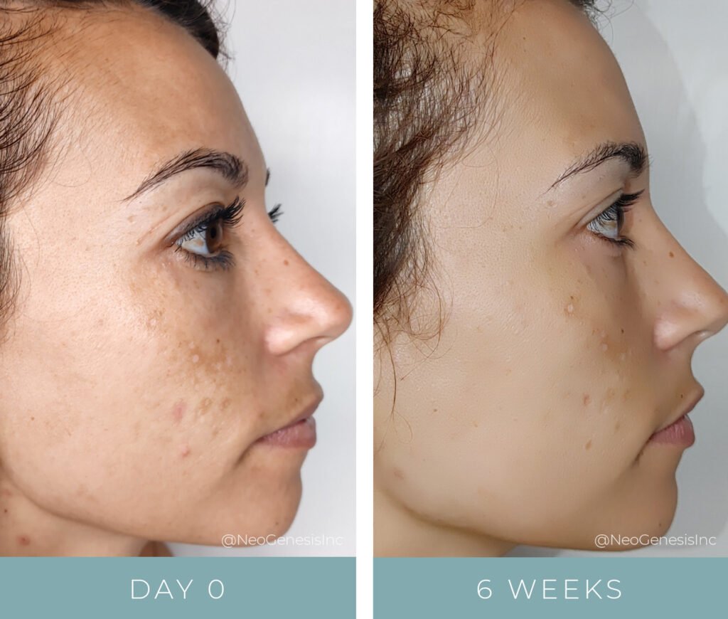 Before + After - Hyperpigmentation + Chemical Peel