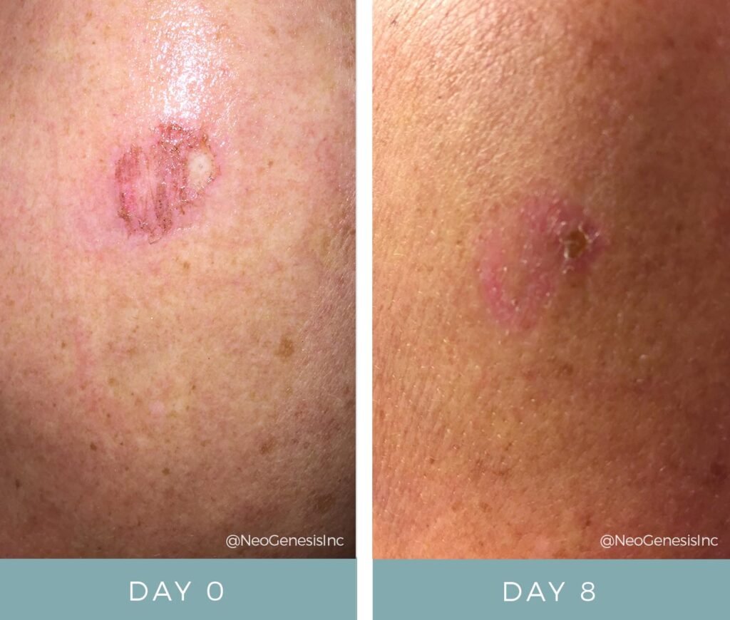 Before + After - Melanoma Skin Cancer Surgery