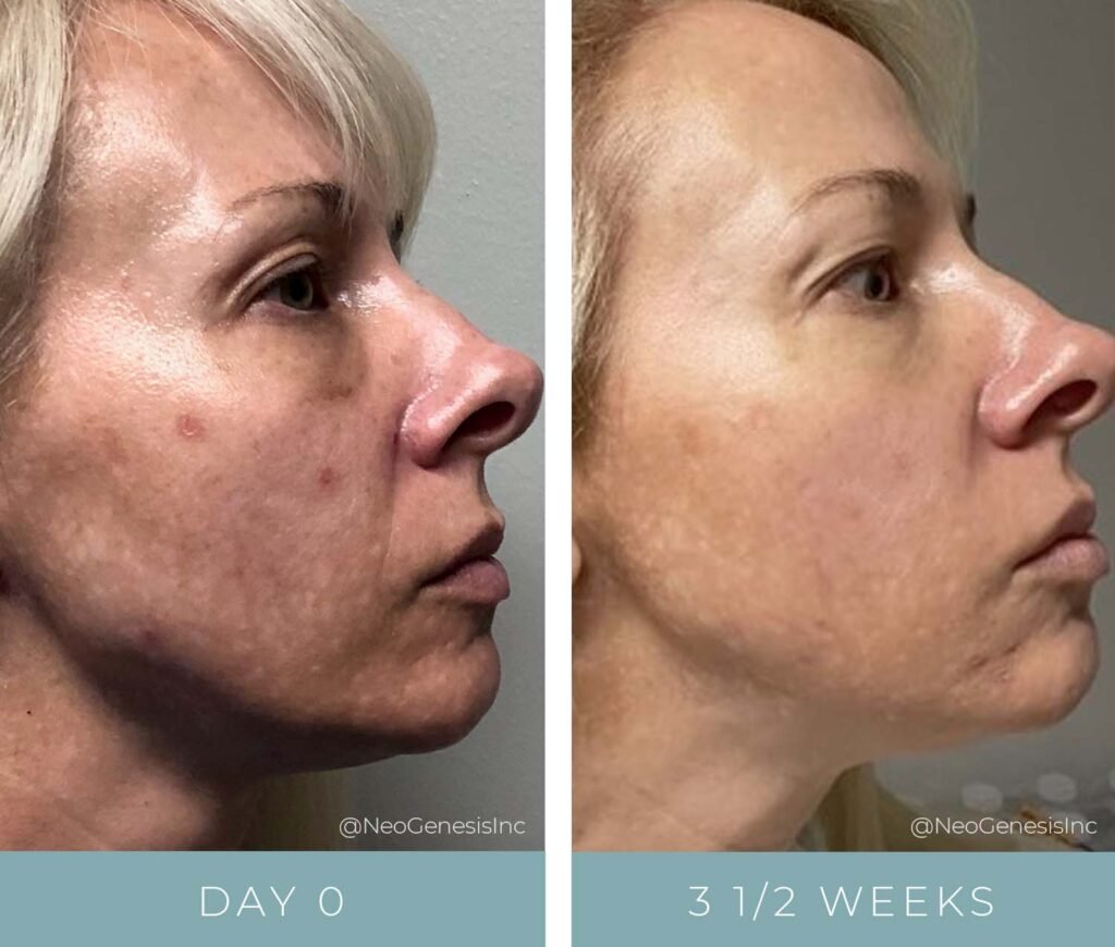 Before + After - Melasma