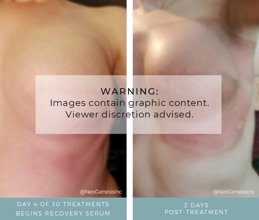 Before + After - Radiation Burns - Breast Cancer