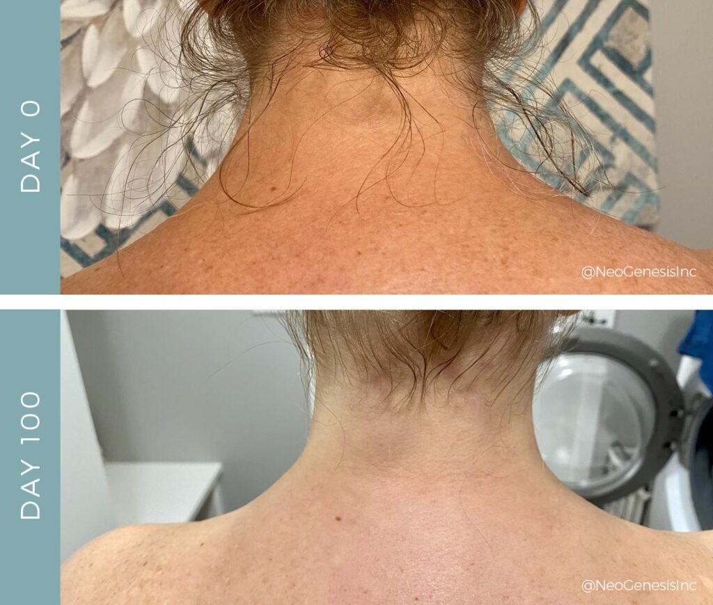 Before + After - Radiation + Chemo for Head and Neck Cancer