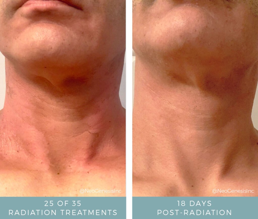 Before + After - Radiation for Head and Neck Cancer