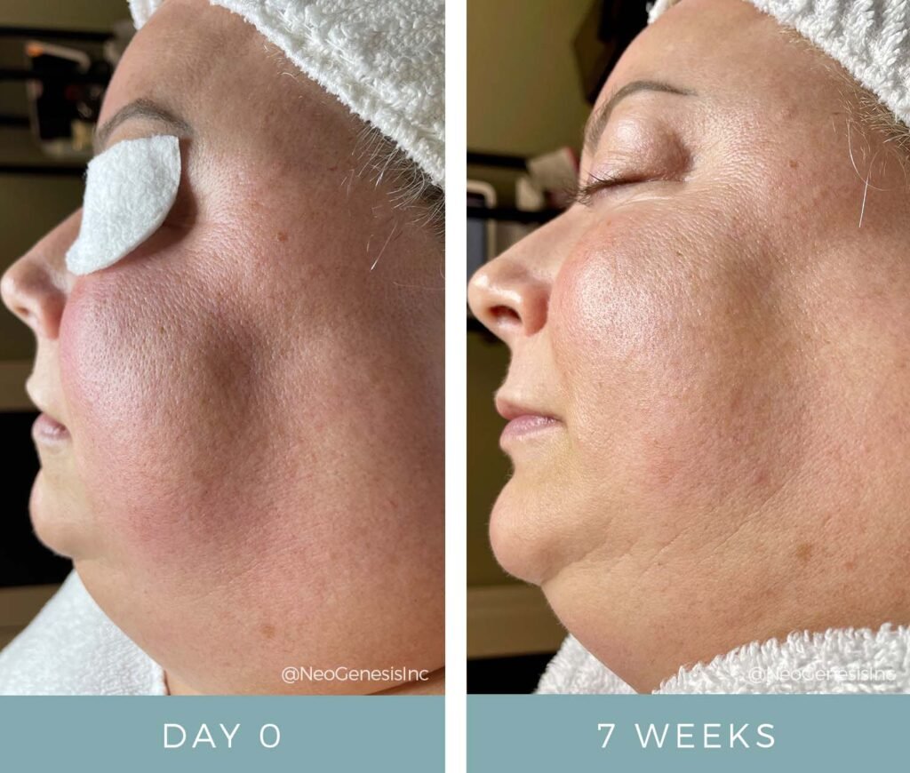 Before + After - Rosacea + Aging Skin