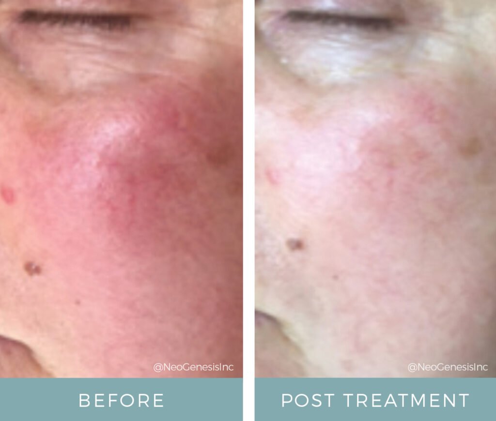 Before + After - Rosacea + Microcurrent