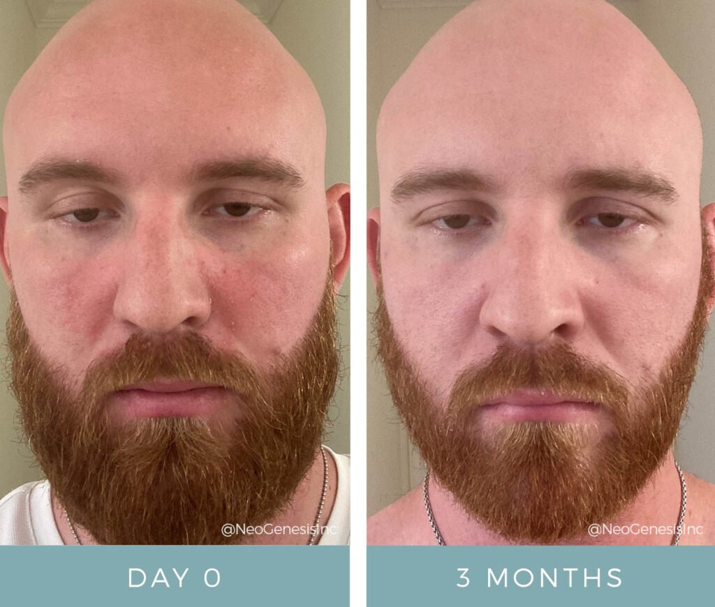 Before + After - Seborrheic Dermatitis