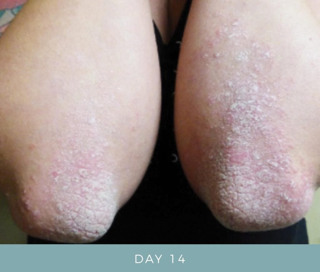 Day 14 - Psoriasis