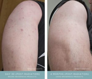 Before + After - Chemo Rash