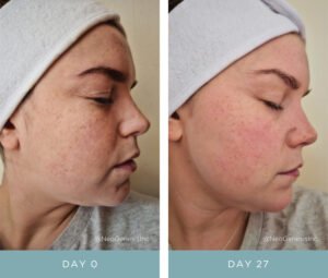 Before + After - Vibrant C Serum for Hyperpigmentation