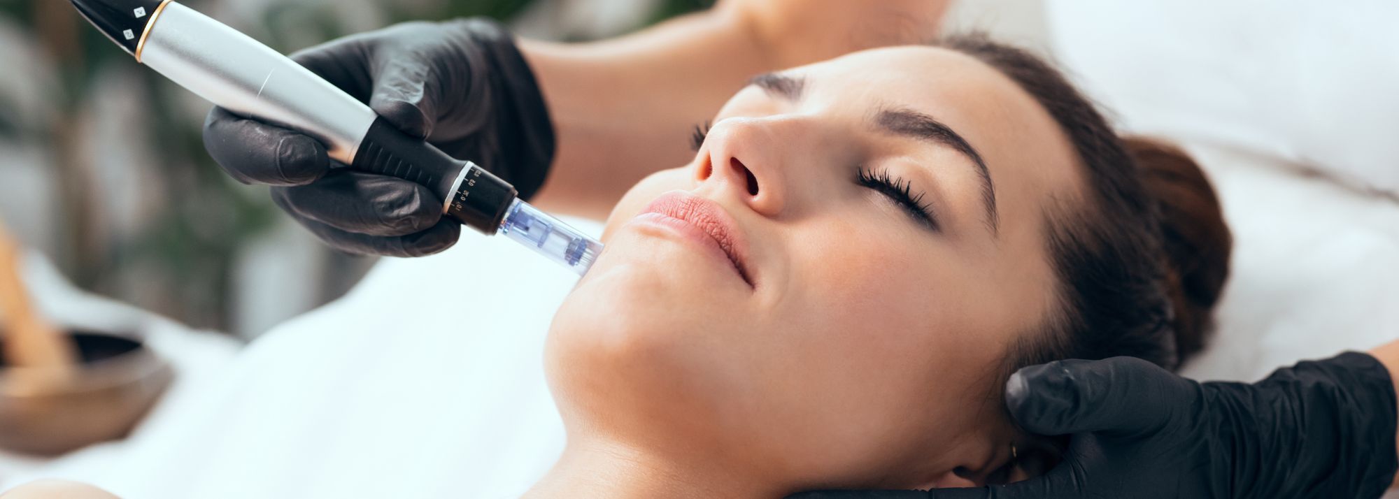 The Ultimate Q&A Guide to Microneedling + Laser Therapy