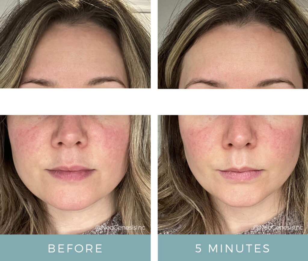Before + After - Vibrant C Serum for Rosacea